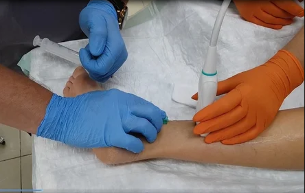 Las venas varicosas de las venas de las extremidades inferiores – el tratamiento de la la escleroterapia